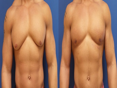 Breast Reduction Treatment